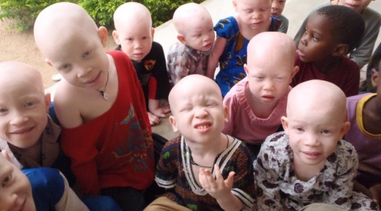 The Sad Plight of Albinos in Tanzania